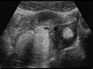 Gynaecology | 3.2 Adnexa : Case 3.2.2 Dermoid cysts ...