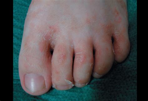 It's been there unchanged for the past 4 weeks and i just new cervical cancer screening guidelines change when and how women should be tested for the disease. Medical Pictures Info - Tinea Pedis