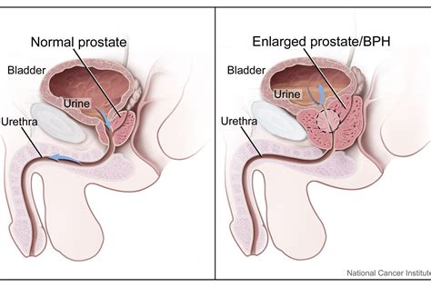 Many prostate cancers grow slowly and are confined to the prostate gland, where they may not cause prostate cancer that's detected early — when it's still confined to the prostate gland — has the best chance for successful treatment. What Are Some Common Prostate Problems?