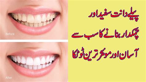 How to whiten yellow teeth naturally. How To Whiten Your Yellow Teeth Naturally at Home | Tooth ...