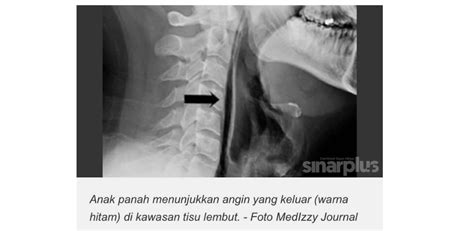 Kirimkan ini lewat email blogthis! Jangan tahan bersin, boleh cederakan organ dan saluran ...