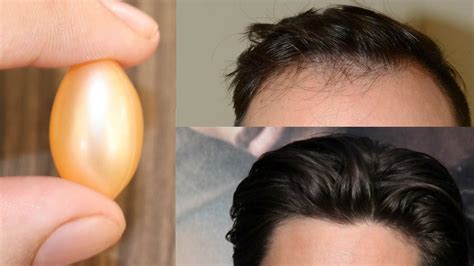 Using vitamin e for hair loss is one of this vital vitamin's many functions. Vitamin E Hair Loss | Spefashion