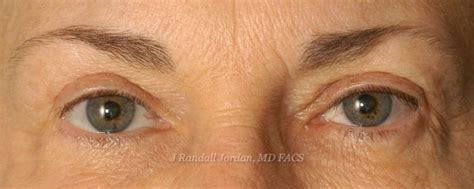 Hours may change under current circumstances Brow Lift Case 2377 - Faces, PLLC in Ridgeland, MS