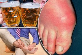 Includes worksheet to help you decide when to seek care. Gout symptoms - tophi gout could be a sign arthritis is ...