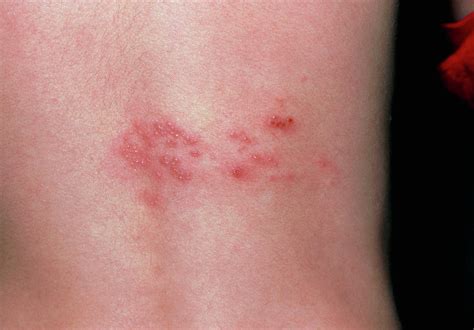 Rash Of Shingles (herpes Zoster) On Lower Back Photograph by Dr P ...