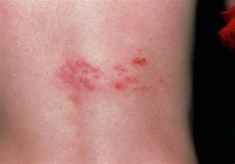 Terminology and types of common childhood rashes. Rash Of Shingles (herpes Zoster) On Lower Back Photograph ...