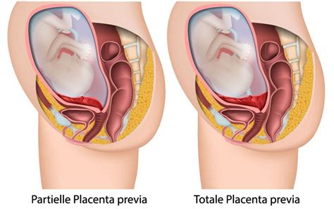 Das baby muss per kaiserschnitt entbunden werden. Plazenta praevia - Ursachen, Therapie & Spezialisten