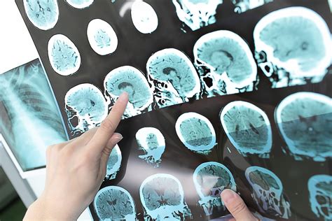 Top 5 benefits of cannabis for multiple sclerosis