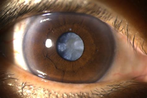 Which type of cataract surgery has a shorter recovery time? Cataract Surgery | Asia Pacific Eye Centre