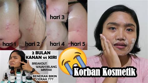 305 likes · 3 talking about this. Jerawat Batu Hilang Dalam 7 Hari ! Wajah Hancur Salah Some ...