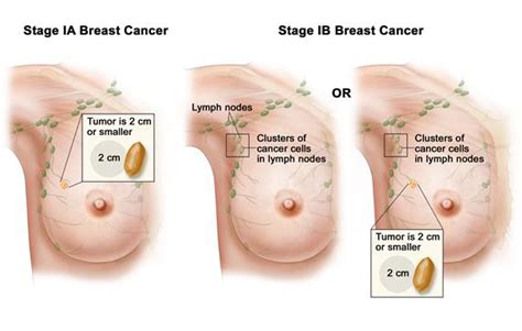 However, these signs and symptoms are most often associated with benign breast. Breast Cancer Pictures | New Health Guide