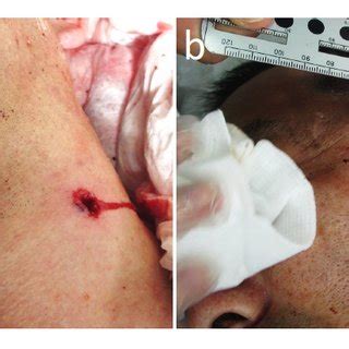 (PDF) Atypical gunshot injury to the neck with an ...