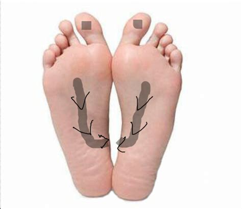 Bunion adalah benjolan pada ibu jari kaki yang dapat menjadi radang. Hidup Adalah Perjuangan: Tips Mengatasi Anyang-Anyangan ...