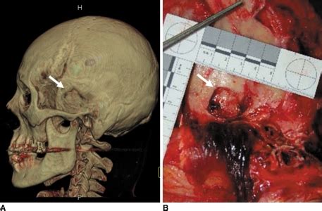 A.50 calibre bullet would have took my arm off so i guess i'm lucky i was just stabbed. 57-year-old man who died due to head injuries from hamm | Open-i