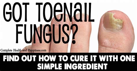 Fungus under acrylic nails nail fungus i am very much sure you must be aware of this phrase as this is the name of a widely spreading nail disease. #WineMakingJuiceKits id:3103700938 #FungusUnderToenailCure ...