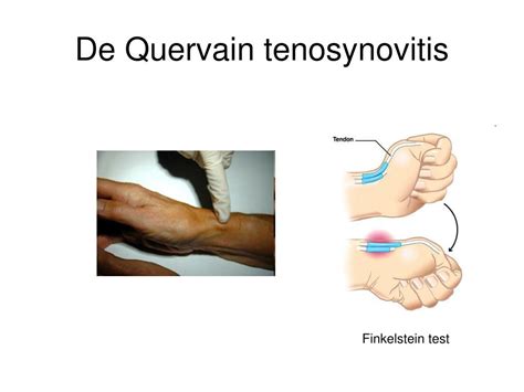 De quervain's tenosynovitis is caused by inflammation and swelling of the tendons of the abductor pollicis longus and extensor pollicis brevis tendons at the level of the radial styloid process. PPT - Áverkar og sjúkdómar í úlnlið PowerPoint ...