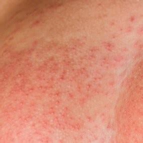 As these inflammatory breast cancer picture shows, the texture of the breast may change and appear to look dimpled or ridged, like an orange peel. Inflammatory Breast Cancer Pictures: Itchy, Rash, Bruised ...