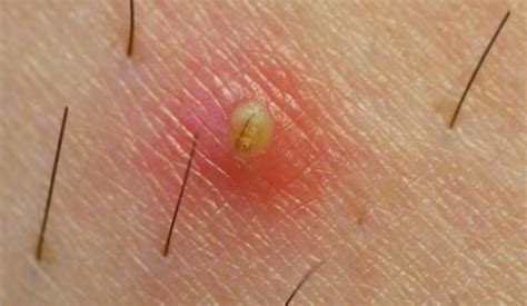 If possible, people should leave ingrown hairs alone to heal and refrain from scratching, shaving, or trying to pop them. Deep ingrown hair can be difficult to remove. The hair ...