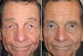 These are non surgical upper eyelids system in the form of non surgical eyelid lift treatment. Eyelid Surgery In Iran | Procedure,Risks,Results,Cost ...