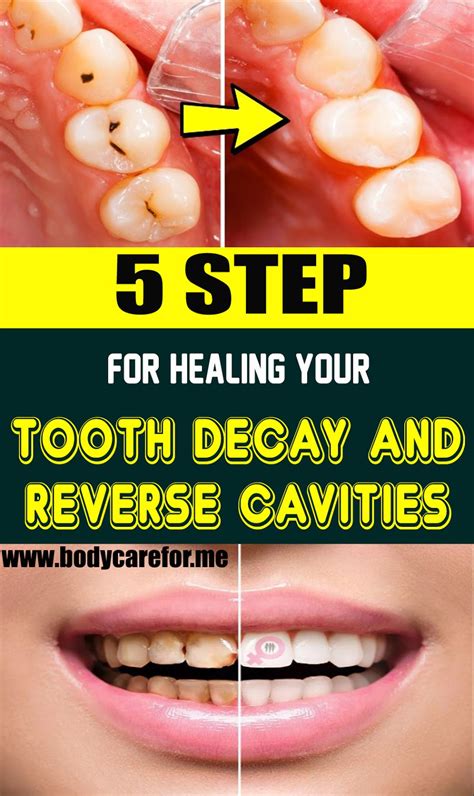 Early tooth demineralization can be reversed. 5 Steps For Healing Your Tooth Decay and Reverse Cavities