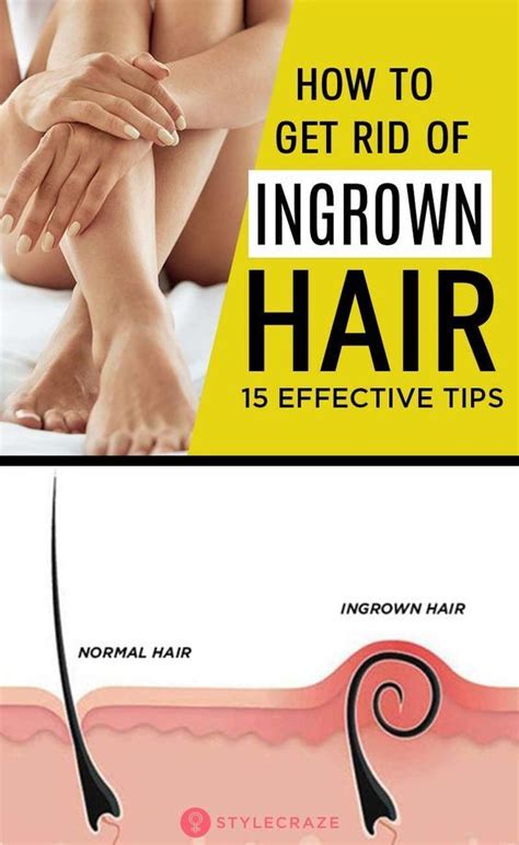 Exfoliating creams may help treat and prevent ingrown hairs by shedding the upper layer of skin so the trapped hairs can break through. How To Get Rid Of Ingrown Hair: Face, Bikini Area, Legs ...