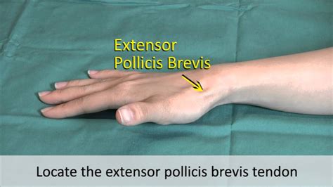 De quervain's tenosynovitis (dqv) is a common hand disorder causing pain along the radial side of the wrist in patients. Musculoskeletal Examination and Joint Injection Series ...