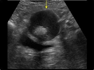 Gynaecology | 3.2 Adnexa : Case 3.2.2 Dermoid cysts ...