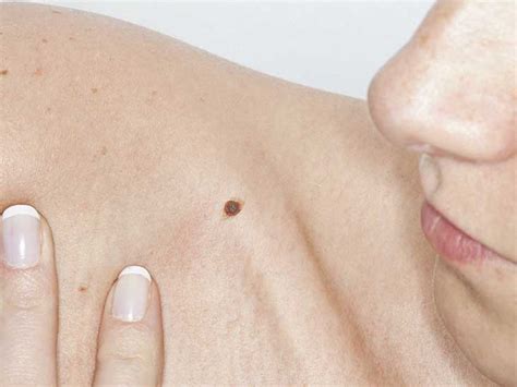 I have a mole on my breast, it's been there for as long as i can remember but over the years it has grown in size and darkened.but then it got smaller but can still see a lighter brown line from when it had grew. Itchy Mole: Causes, Treatment, Symptoms and More
