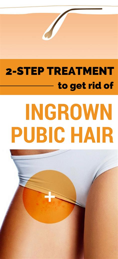 While they're annoying, ingrown hairs usually go away stop removing your pubic hair until your ingrown hair heals. How To Treat An Ingrown Hair | Galhairs