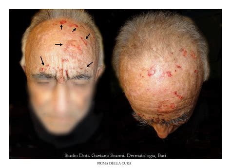 Prurito Senile - Dr. Gaetano Scanni