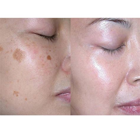 We did not find results for: Pigmentation Removal Laser - DR SIN YONG