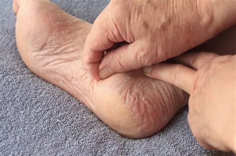 How to remove calluses on feet. Permanent Callus Removal | LIVESTRONG.COM