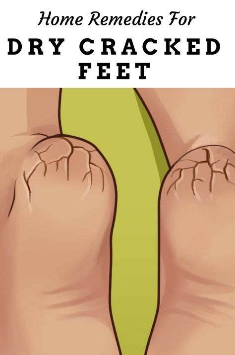 Your feet will surely be clean and tingly when you are done, especially if you use cool mint there have been several things written supporting the notion that vinegar and water soaks can be used to soften dry, cracked heels. Home remedies for dry, cracked feet. Why you should soak ...