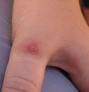 A black widow spider bite is diagnosed through a physical examination and questions about the bite. Arachnophobia!: The Truth Behind Spider Bites