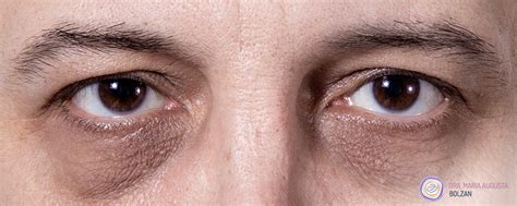 Lingkaran gelap bawah mata menjadi masalah yang sering dihadapi oleh banyak wanita. Eyebag Di Bawah Mata Boleh Hilang. Senang Je Rupanya ...