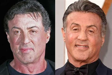Lifting the tip of the nose with botox application or especially when laughing, it is possible to narrow its wide wings. Sylvester Stallone Plastic Surgery: Facelift, Botox and ...
