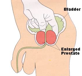 Your doctor may use a needle to take tissue samples of lymph nodes. How to Know If You Have Prostate Cancer