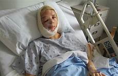 girl face half teen facial rare sarah deformity after atwell