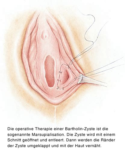 Das geschah aber nicht wegen des aussehens ~~ frauen haben größere äußere schmlippen. Bartholinitis, Bartholinzyste, Entzündung der ...