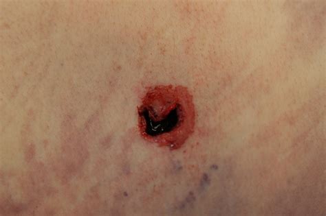 Gunshot wounds commonly show a point of entry called the entry wound. Shored exit gunshot wound | Injuries and wounds ...