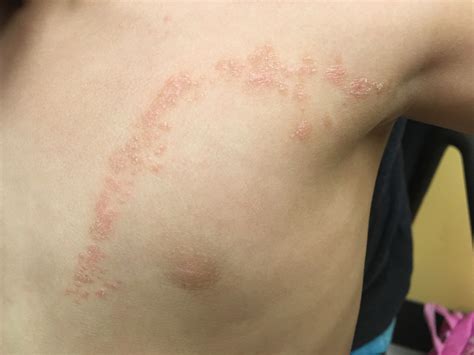 Biopsy from an already scarred area of hair loss is unhelpful. Lichen Striatus | Consultant360