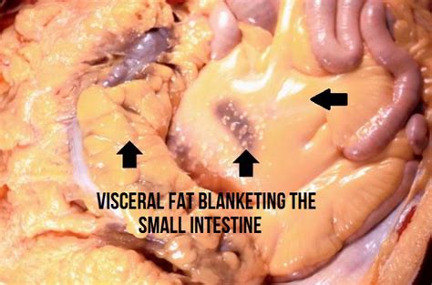 Visceral fat is the accumulation of fat on our body, but it does not accumulate in the subcutaneous layers of the waist and thighs, and around the abdominal organs. Visceral Fat Confirmed Dangerous to Your Health
