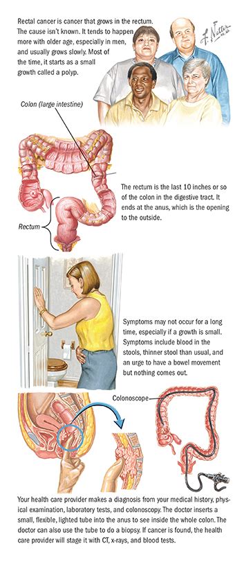 Fighting rectal cancer is going to be hard work. Rectal Cancer | Colorectal Cancer | Spectrum Health
