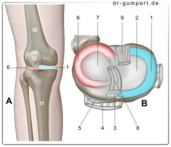 Man kann sich das so vorstellen, als wäre der meniskus in zwei scheiben geschnitten und ein stück des oberen teils sondert sich ab. Meniskus