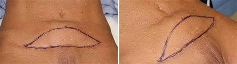My stomach is still swollen, hard, and sore 2 months after tummy tuck surgery. Plastic Surgery Case Study - Treatment of Chronic ...