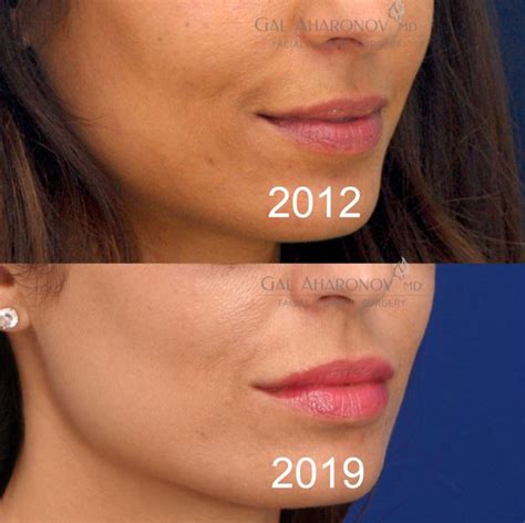 This is done by increasing volume in the upper lip, to help block the sight of the gummy smile. Lip Augmentation & Gummy Smile | Plastic Surgery