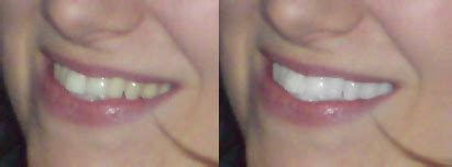 Am besten du fragst einfach mal bei deinem zahnarzt nach. Zähne in Fotos weißer machen