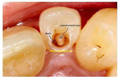 DENS IN DENTE: Maxillary Lateral Incisor - Ovi Dental