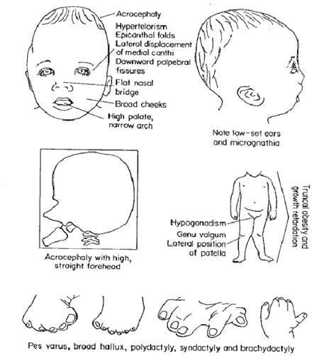 Flat nasal bridge and bilateral epicanthal fold download. Flat Nasal Bridge And Epicanthal Folds / Chromosomal ...