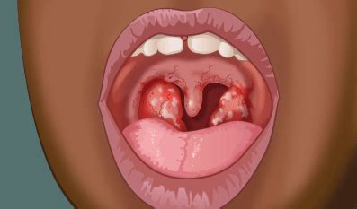 Sore throats from strep will usually improve on their own; Sore throat in children - symptoms and treatment of ...